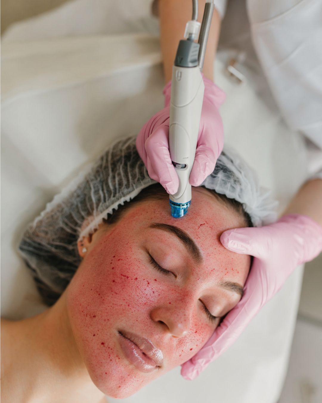 Aesthetician applying a microneedling pen to a client's face